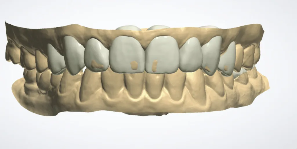 diseño de carillas dentales digitales