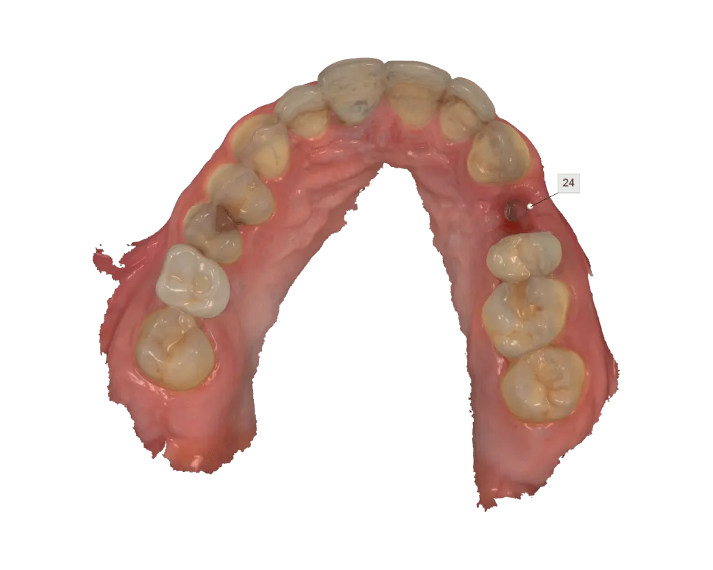 Prótesis Dental Sobre Implantes