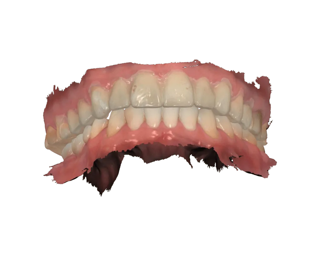 escaneo de carillas dentales digitales mock-up