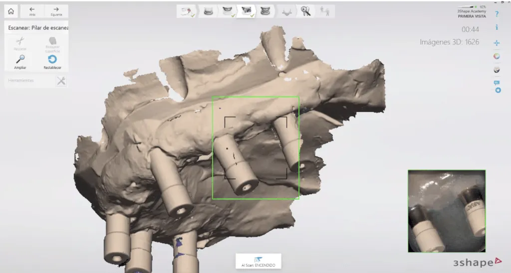 escaneo scan body-Laboratorio Dental Digital 