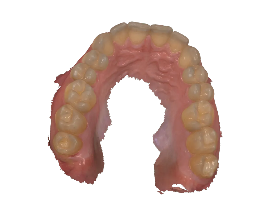 La Férula de Descarga 3D: Splint