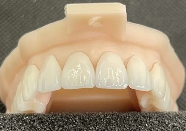 modelo 3d para carillas