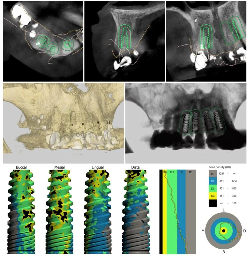 Guías Quirúrgicas 3D