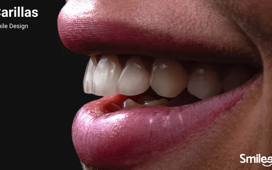 Carillas Dentales de Calidad: Protocolo Digital para Clínica Dental