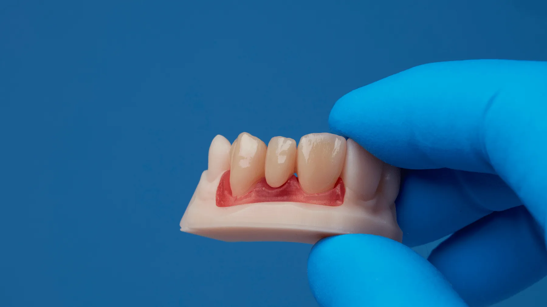 Corona de zirconio fabricada con flujo digital CAD-CAM
