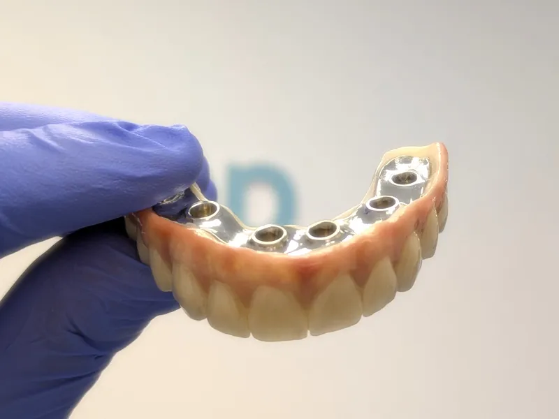 Prótesis fija sobre implantes atornilladas fabricada con CAD-CAM