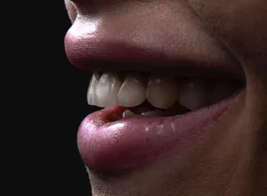 Carillas Dentales