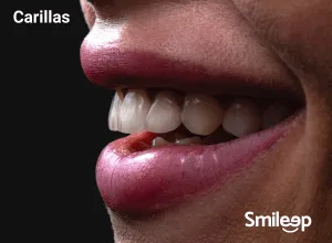 Carillas Dentales